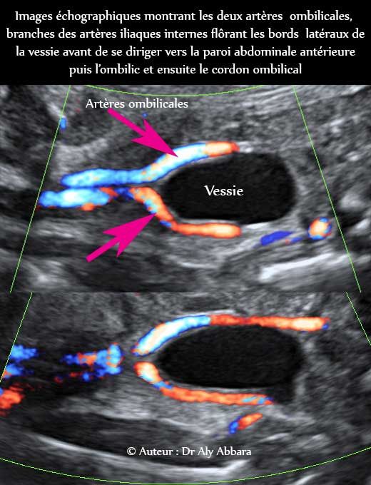 Rapport anatomiques au niveau du pelvis des artères ombilicales avec la vessie